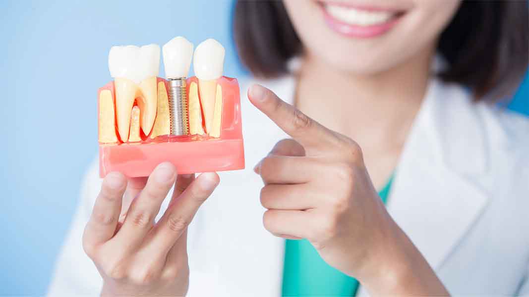 Implantes Dentários